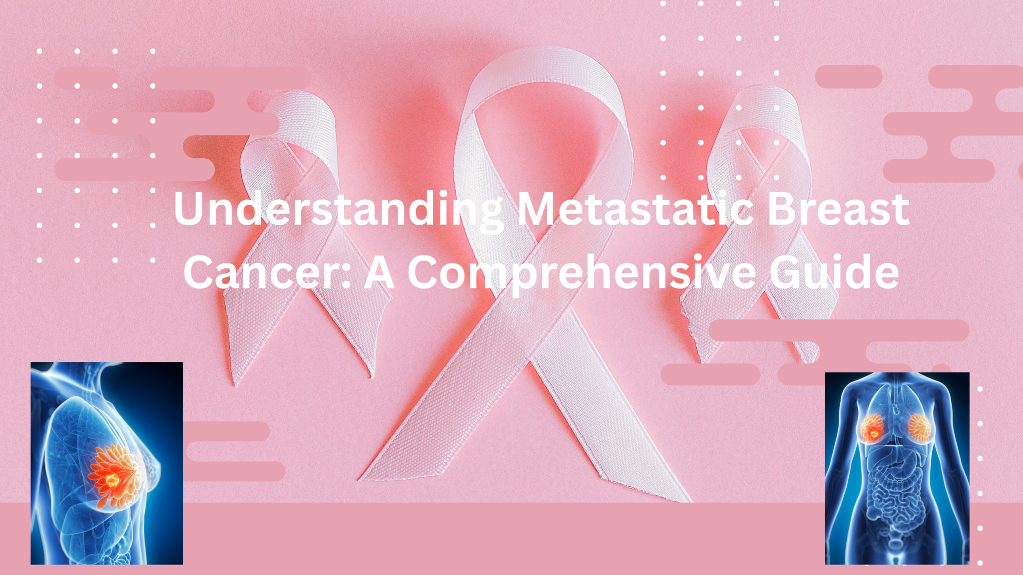 Understanding Metastatic Breast Cancer: A Comprehensive Guide